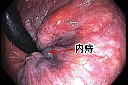 痔疮直肠镜图片