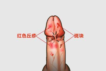 生殖器出现红色丘疹和斑块