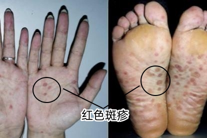 掌心、脚掌红色斑疹