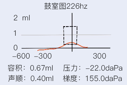 鼓室图226hz