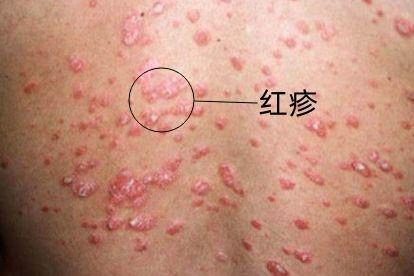 寻常型银屑病皮疹图片