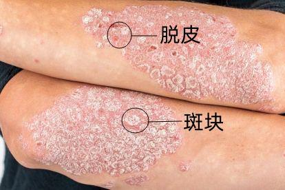 寻常型银屑病斑块图片