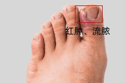 嵌甲图片