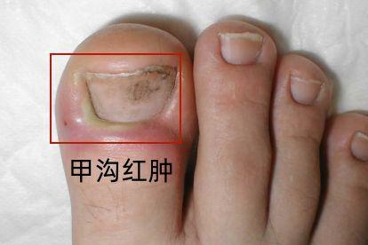 甲沟炎图片