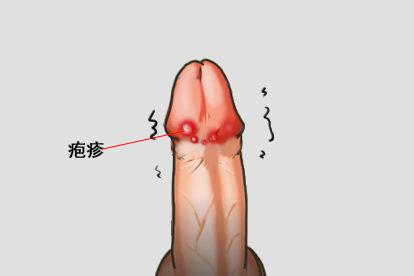 生殖器官感染疱疹图片