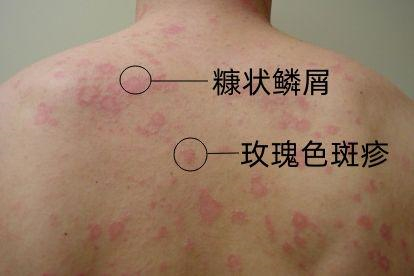 玫瑰糠疹晚期图片