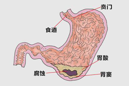 胃酸腐蚀胃窦图片