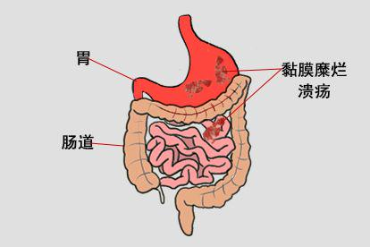 应激性溃疡图片