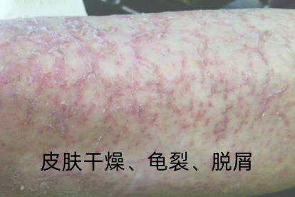 干性湿疹图片