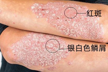 银屑病图片