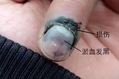 指甲发黑指甲外伤图片