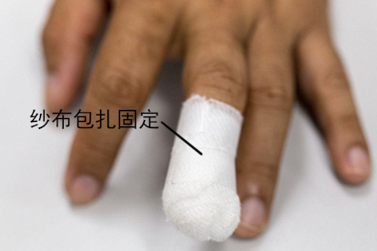 指甲外伤纱布包扎固定图片