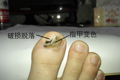 指甲发黑甲癣图片