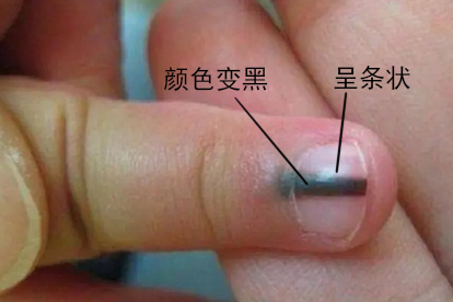指甲发黑甲母痣图片