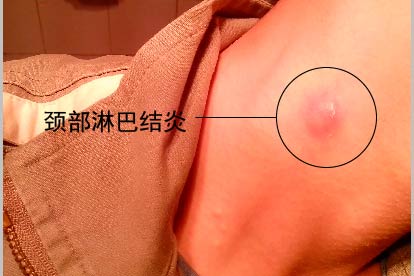 颈部淋巴结炎图片