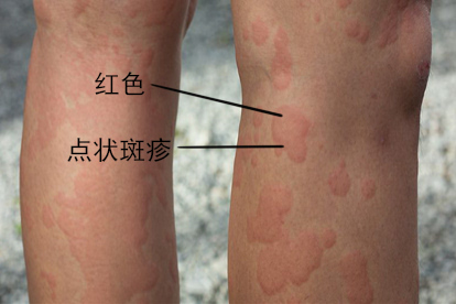 身上灰红不痒花斑糠疹图片