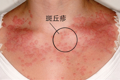 身上灰红不痒银屑病图