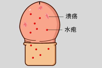 男人生殖器疱疹图片