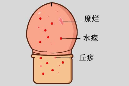 男人生殖器上长水疱什么原因图片