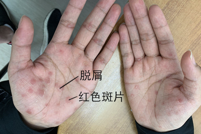 身上灰红不痒梅毒疹图