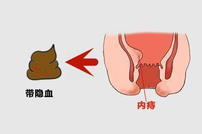 内痔图