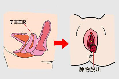 肿物自阴道脱出图