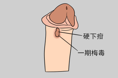 一期梅毒图片