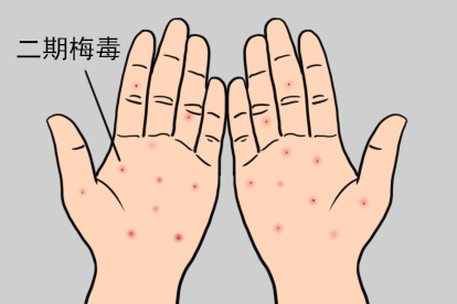 二期梅毒图片