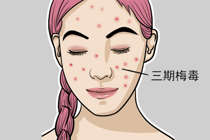 三期梅毒图片