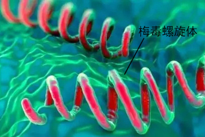 梅毒螺旋体感染引起梅毒图片