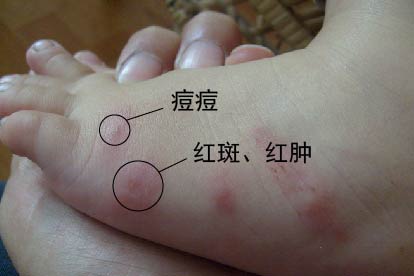 丘疹性荨麻疹图
