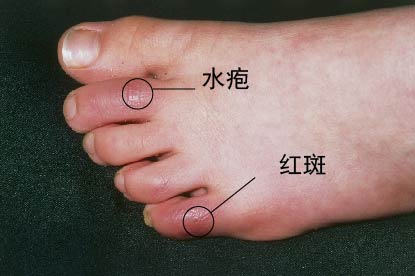 冻疮图