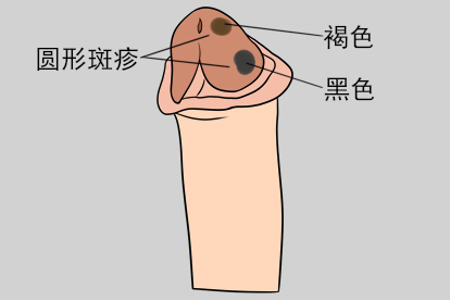 阴茎头上有黑点色素痣图