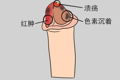 阴茎头上有黑点龟头炎图