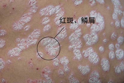寻常型银屑病图