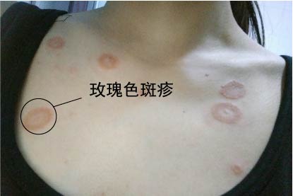 玫瑰糠疹图