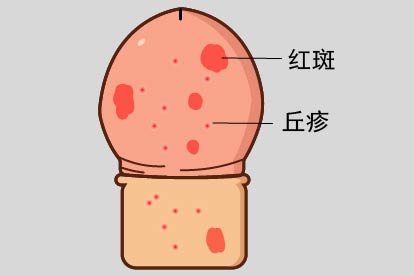 湿疹图片
