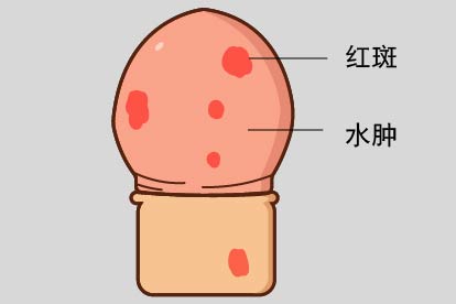 龟头炎图片