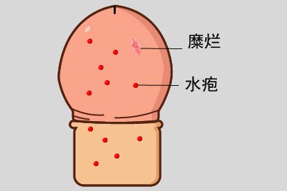 生殖器疱疹图片