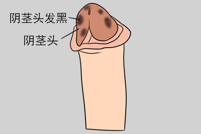 阴茎头上有黑色点怎么办图片