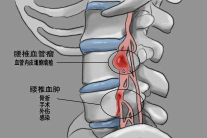 腰椎血肿和腰椎血管瘤的病因