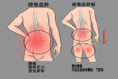 腰椎血肿和腰椎血管瘤的症状