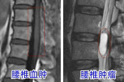 腰椎血肿和腰椎血管瘤的影像学