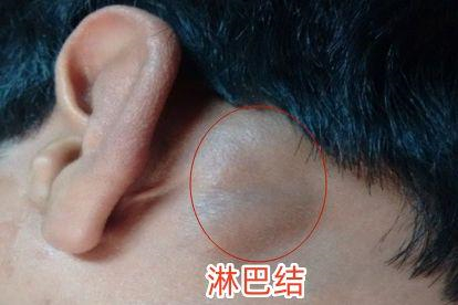 女性梅毒淋巴结肿大初期图