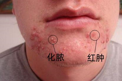 毛囊炎图