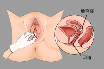 黄体酮栓塞到深处实践操作图