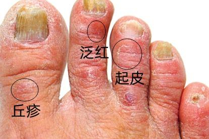 足癣图