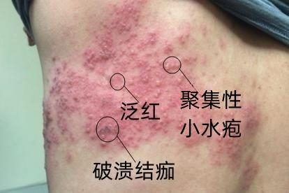 单纯疱疹图