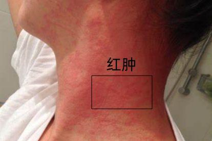 过敏性皮炎