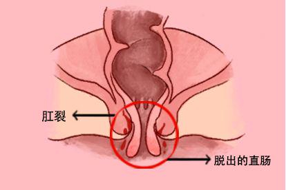 肛裂图片